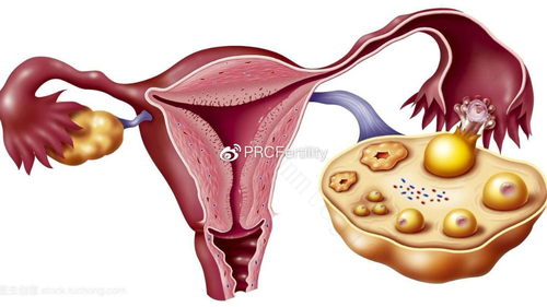 卵巢囊肿能根治吗？卵巢囊肿的治疗方法有什么？