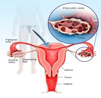 多囊卵巢最佳治疗方法能怀孕