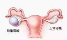 女性患多囊卵巢备孕有影响吗知乎