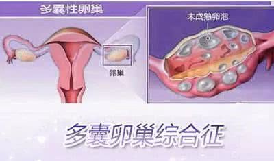 女性患多囊卵巢备孕有影响吗知乎