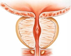 盆腔积液容易宫外孕吗女性