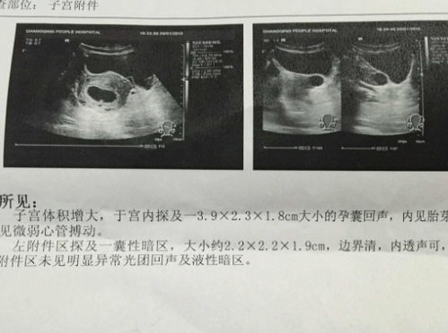 孕囊形状不好