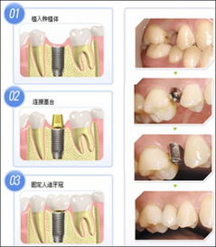 做一颗种植牙要多少钱？