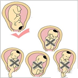 胎位不正的纠正及注意事项视频