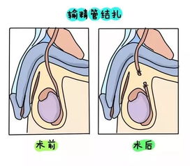 男性结扎之后会影响性生活吗