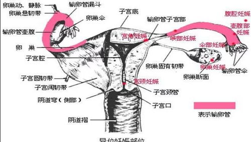 宫颈妊娠属于宫外孕吗?