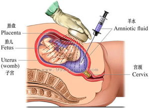 羊水穿刺能排畸形吗