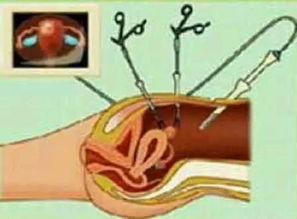 妇科腹腔镜手术中,哪些细节不容忽视