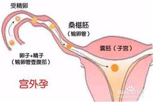 宫外孕早期症状有哪些表现