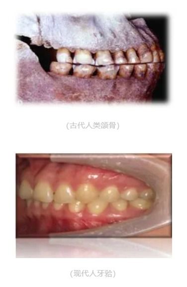 拔牙后种植牙好还是牙齿矫正好