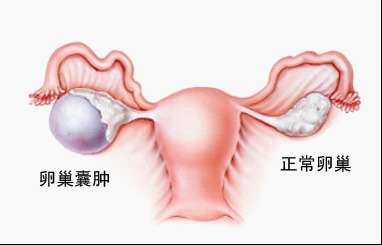 卵巢囊肿食疗最有效果有哪些