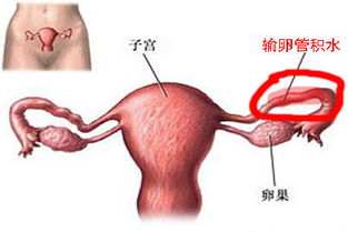 输卵管积水怎么治好多少钱