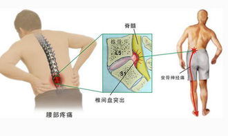 腰椎间盘突出压迫坐骨神经疼右腿疼怎么治疗