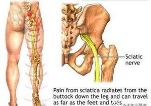 腰椎间盘突出压迫坐骨神经疼右腿疼怎么治疗