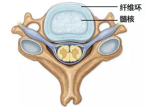 腰椎间盘突出压迫坐骨神经疼右腿疼怎么治疗