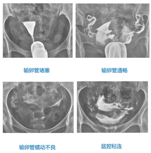 女性做输卵管通水痛吗