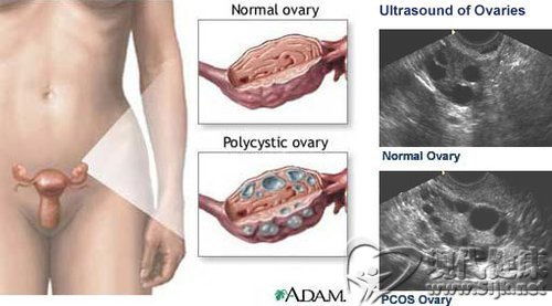多囊性卵巢会影响怀孕吗