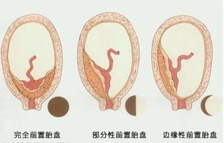 胎盘前壁与胎盘后壁有什么区别呢