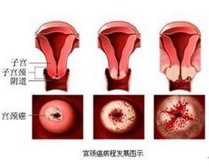 孕期如何预防宫颈糜烂的发生呢