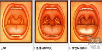 孕妇扁桃体发炎可以吃肉吗早期