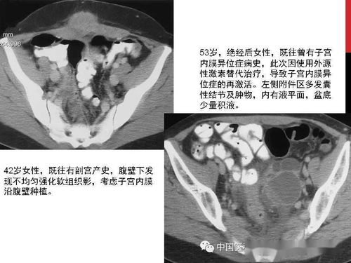 黄体囊肿破裂会导致盆腔积液么