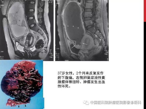 黄体囊肿破裂会导致盆腔积液么