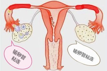 输卵管不通介入治疗有用吗?