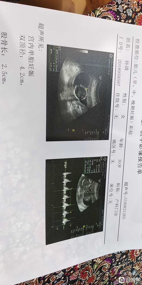 脑血管超声检查结果多久能出来？