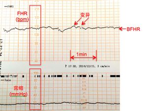 胎心监护宫缩怎么看