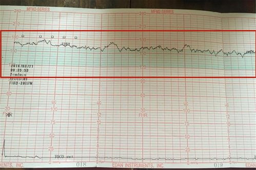 胎心监护宫缩怎么看