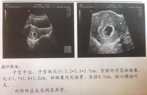 孕囊大小为4.9乘3.4mm是否可以看出胎儿性别