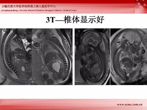 胎儿磁共振能检查什么部位