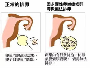 多囊卵巢综合征是什么原因引起的,该怎么治疗