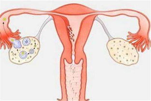 多囊卵巢综合征是什么原因引起的,该怎么治疗