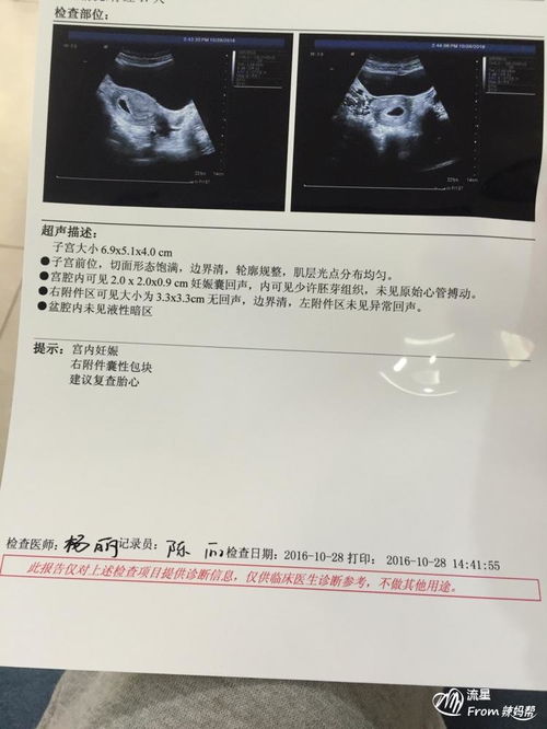 怀孕15天左右做b超能查出来吗