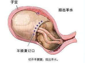 怎么知道自己胎膜早破流血吗