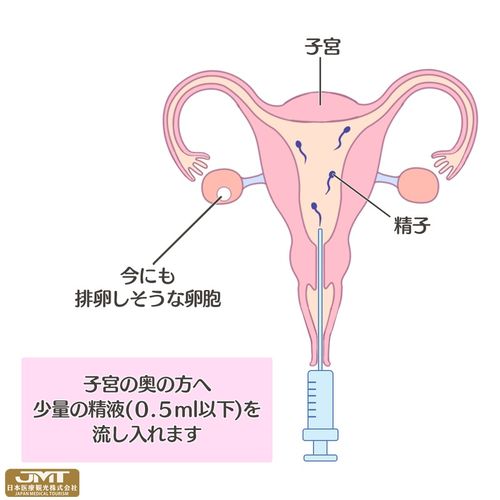 少精做人工授精有影响吗