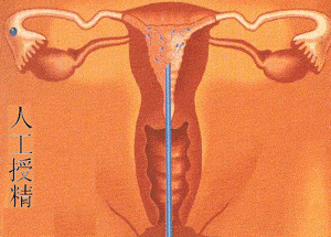 少精做人工授精有影响吗