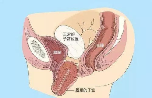 女性前庭大腺炎怎么引起的