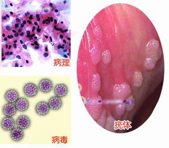 尿路感染反复发作怎么办女性