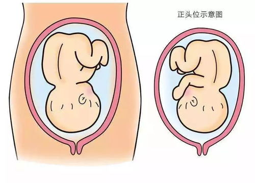 胎位不正一定要剖腹产吗?