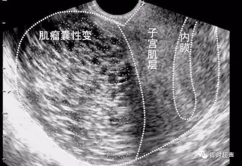 无回声区多久会变孕囊和卵黄囊