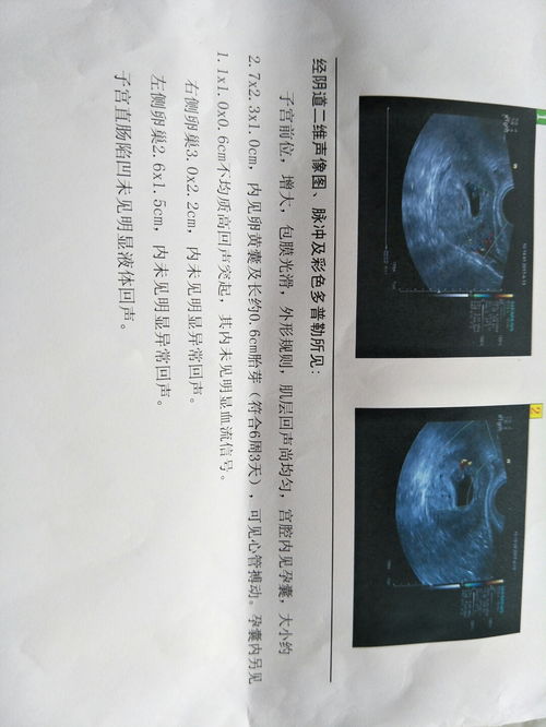 孕囊大小是否正常