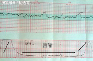 胎心监护nst是什么意思