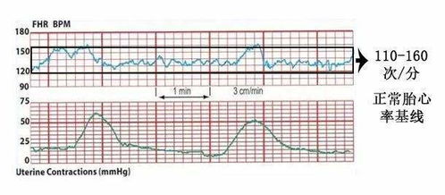 做胎监变异幅度大