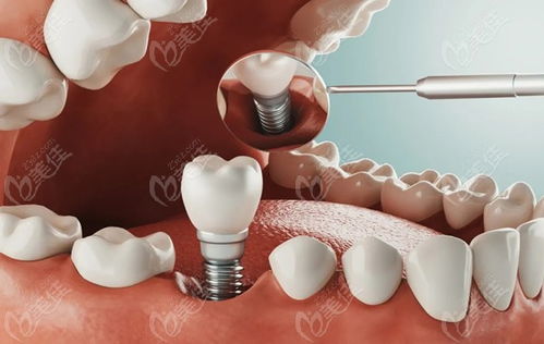 种植牙价格?重庆哪里种植牙最便宜?