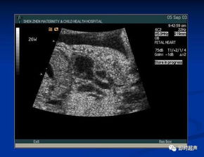 怀孕5个月宝宝心脏有0.22厘米缺口