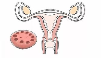 双侧多囊卵巢和多囊卵巢综合症一样吗