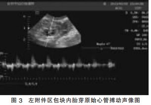 宫内早孕约6w5d什么意思