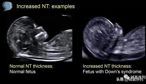 超声检查nt异常怎么办啊